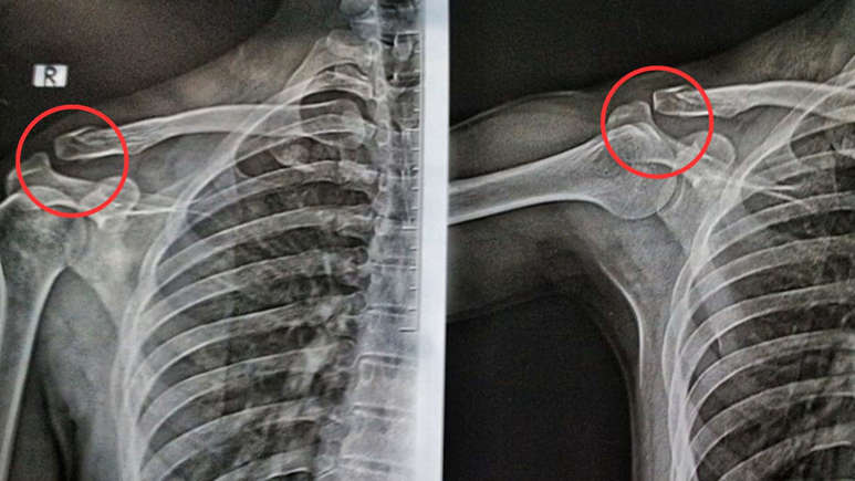 NHS States Eating These Foods More Than Once A Week May Weaken Your Bones Over Time
