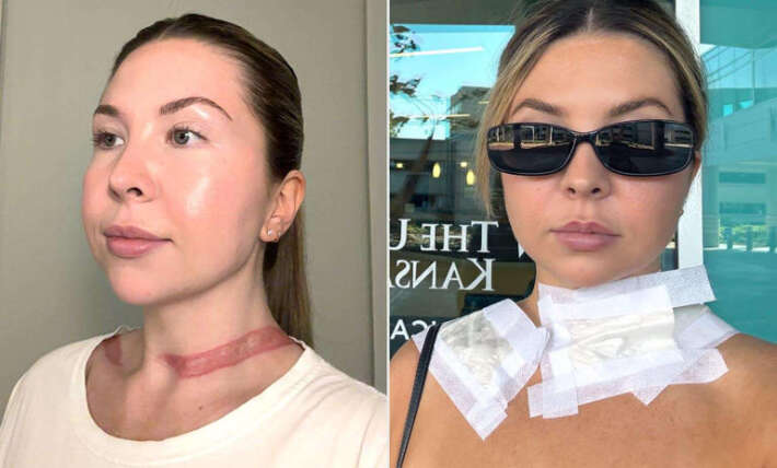 Woman issues warning after her scarf strangled her because it got tangled in a car tire, leaving a friction burn (exclusive)