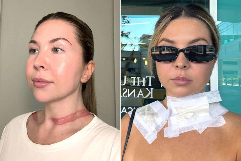 Woman issues warning after her scarf strangled her because it got tangled in a car tire, leaving a friction burn (exclusive)
