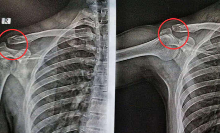 NHS States Eating These Foods More Than Once A Week May Weaken Your Bones Over Time